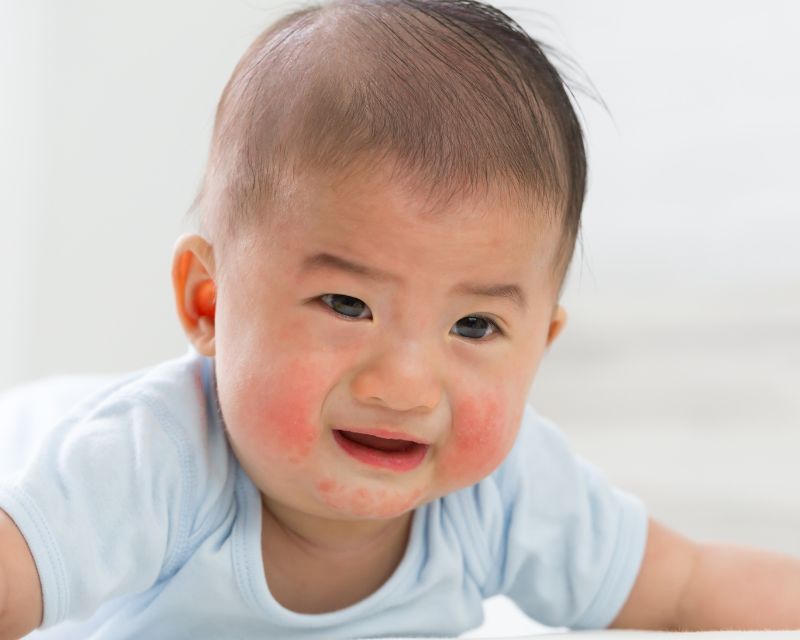 "Mụn Sữa Ở Trẻ Sơ Sinh - Làm Sao Để Xử Lý Mà Không Gây Hại Cho Làn Da?" 3 Làm thế nào để nhận biết mụn sữa ở trẻ sơ sinh?