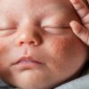 Mụn Sữa Ở Trẻ Sơ Sinh - Làm Sao Để Xử Lý Mà Không Gây Hại Cho Làn Da