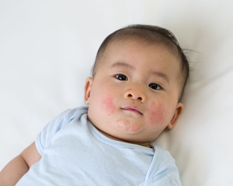 "Mụn Sữa Ở Trẻ Sơ Sinh - Làm Sao Để Xử Lý Mà Không Gây Hại Cho Làn Da?" 2 Mụn sữa ở trẻ sơ sinh là gì? có nguy hiểm cho trẻ không?